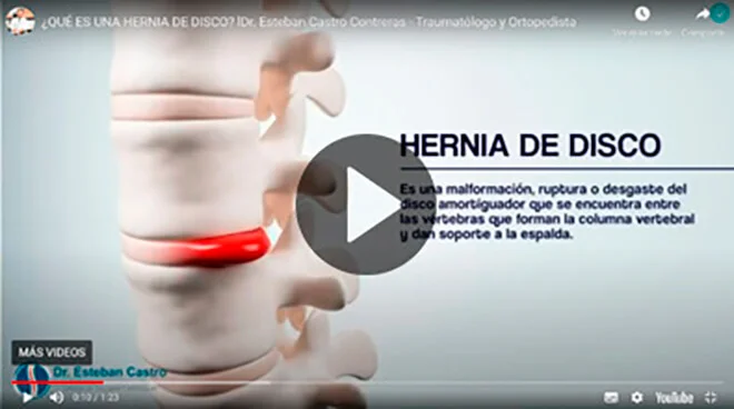 Hernia de Disco Dr. Esteban Castro Contreras - Traumatólogo y Ortopedista